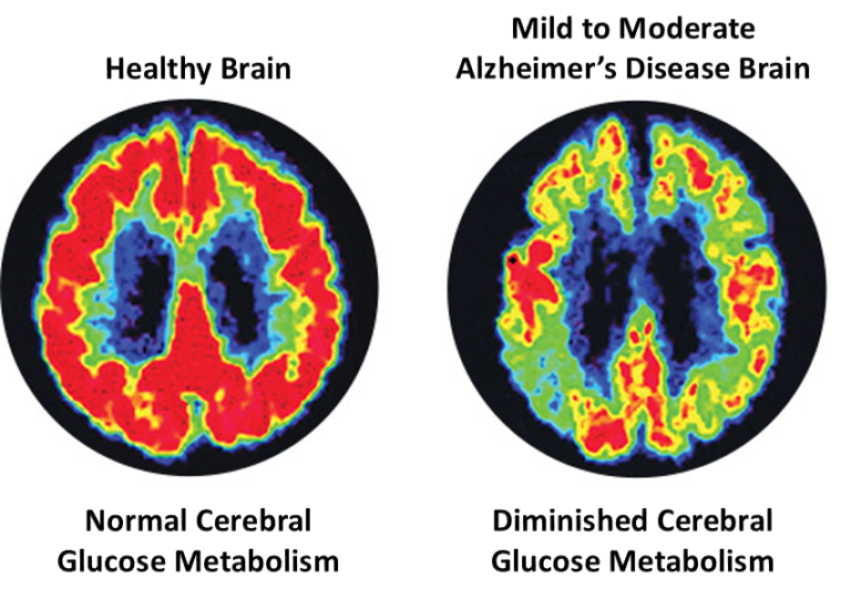 Healthy vs. Diseased Brain | Functional Strength